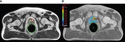 Health-related quality of life of salvage prostate reirradiation using stereotactic ablative radiotherapy with urethral-sparing